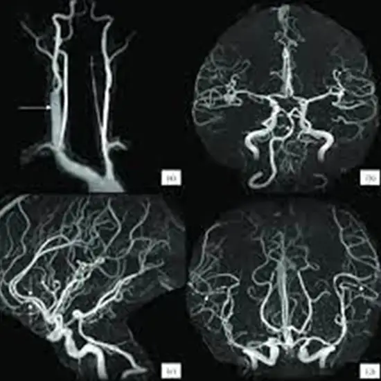 MR Angiography Intra and Extracranial Vessels